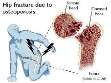 hip_osteoporosis-63